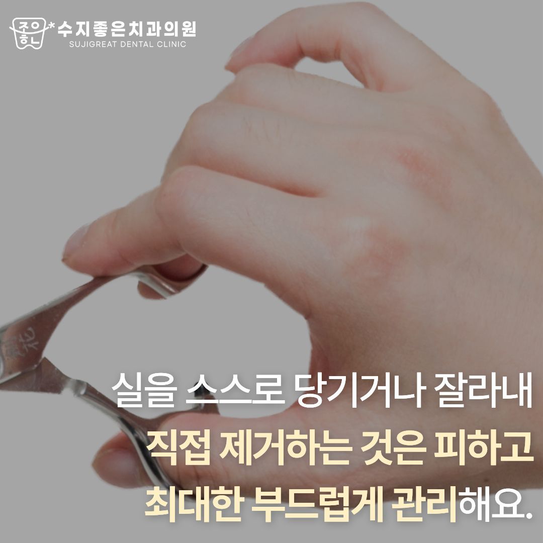 사랑니 발치 후 실밥 (3/4)