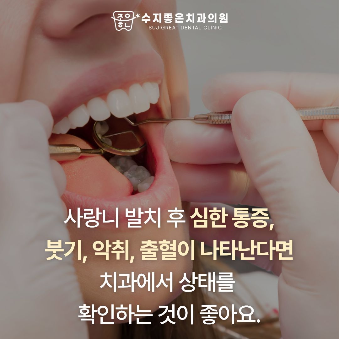 사랑니 발치 후 실밥 (4/4)