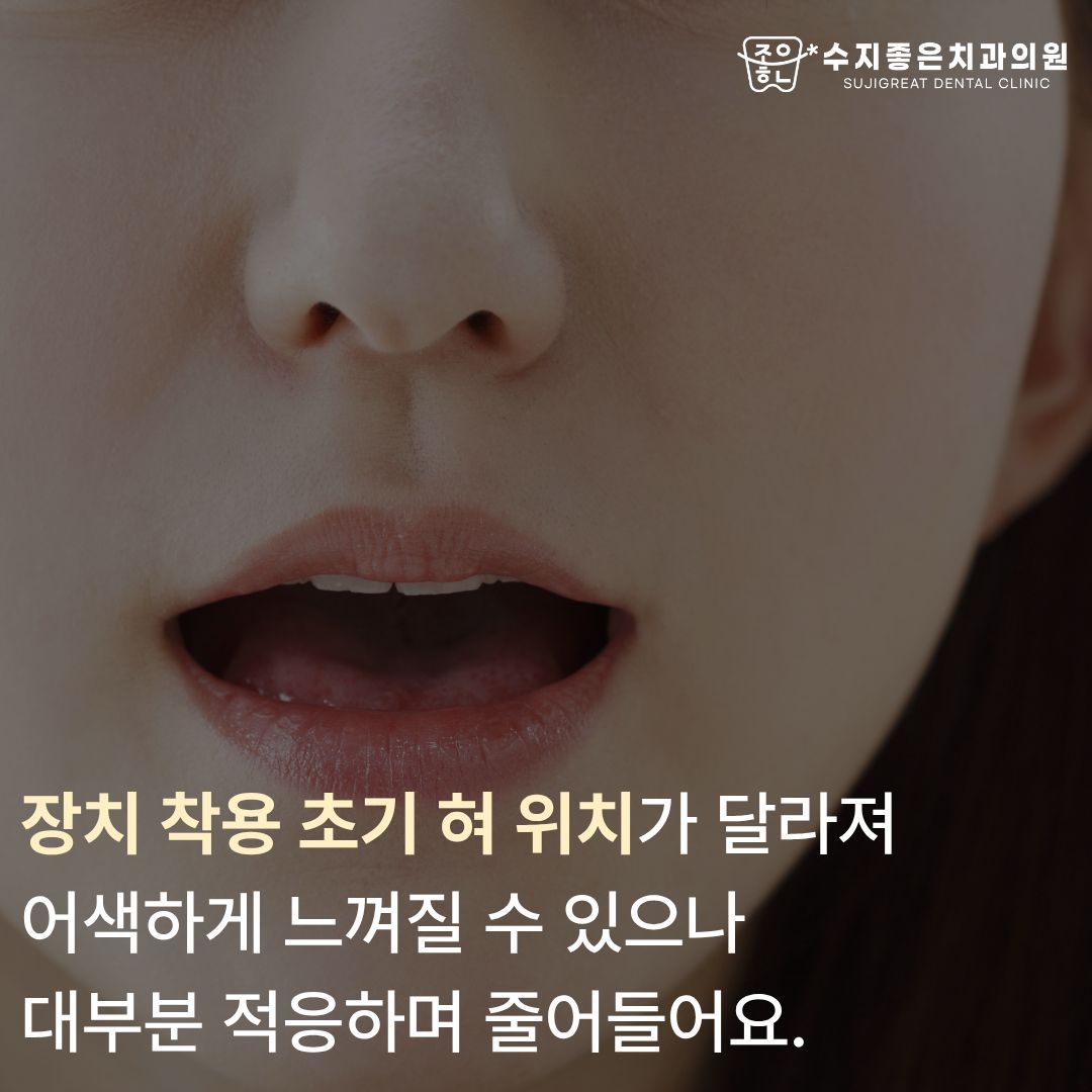 입을 벌린 얼굴 — 장치 착용 초기 혀 위치가 달라져 어색하게 느껴질 수 있으나 대부분 적응하며 줄어들어요