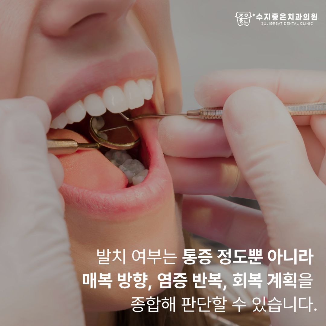 치과 기구로 입안을 검사하는 모습 — 발치 여부는 통증 정도뿐 아니라 매복 방향, 염증 반복, 회복 계획을 종합해 판단할 수 있습니다